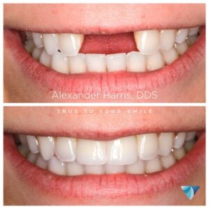 Dental implants in Lehi UT patient before and after photos