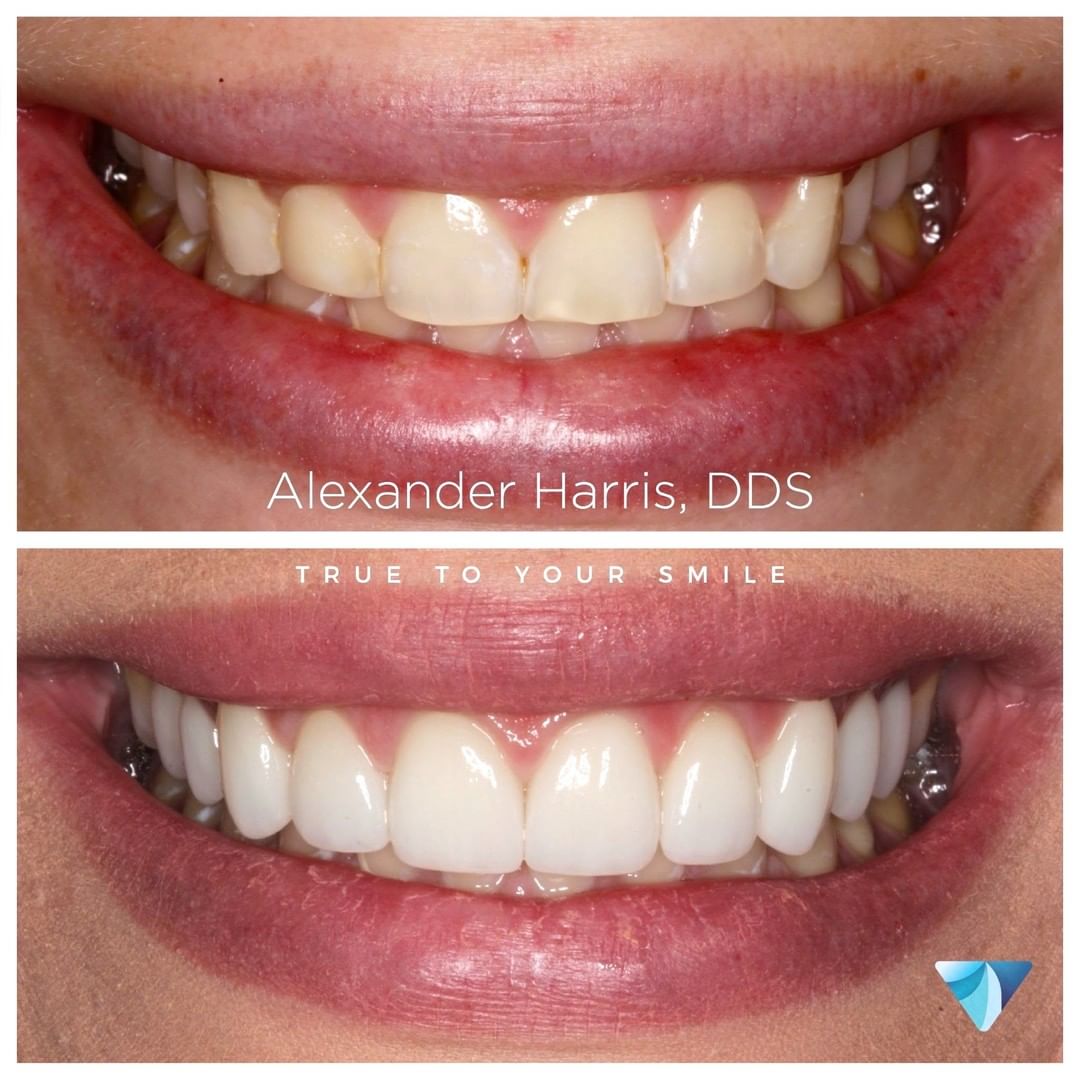 Before and after photos of Provo UT dental patient who received minimally prepped veneers
