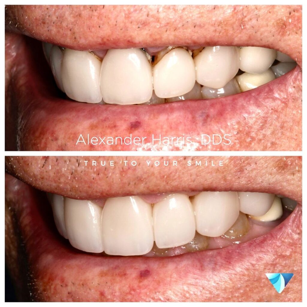 Smile design before and after photos in Lehi UT at Vero Dental
