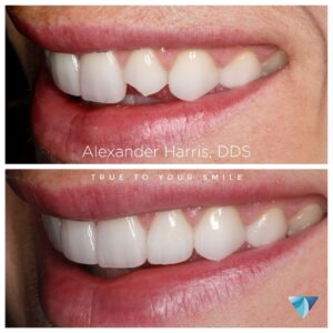 Lehi UT dental patient before and after photos of broken tooth repair