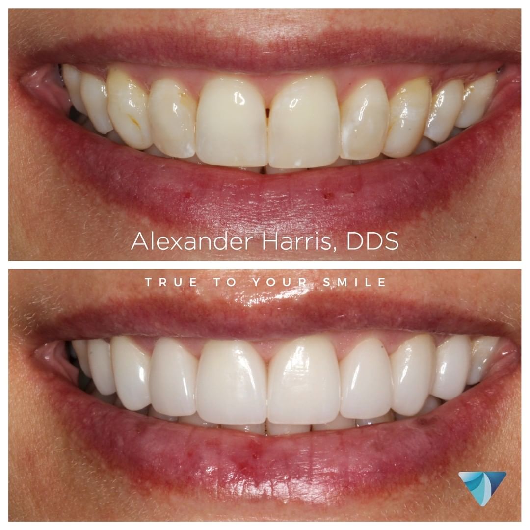 Before and after photos of patient with dental veneers