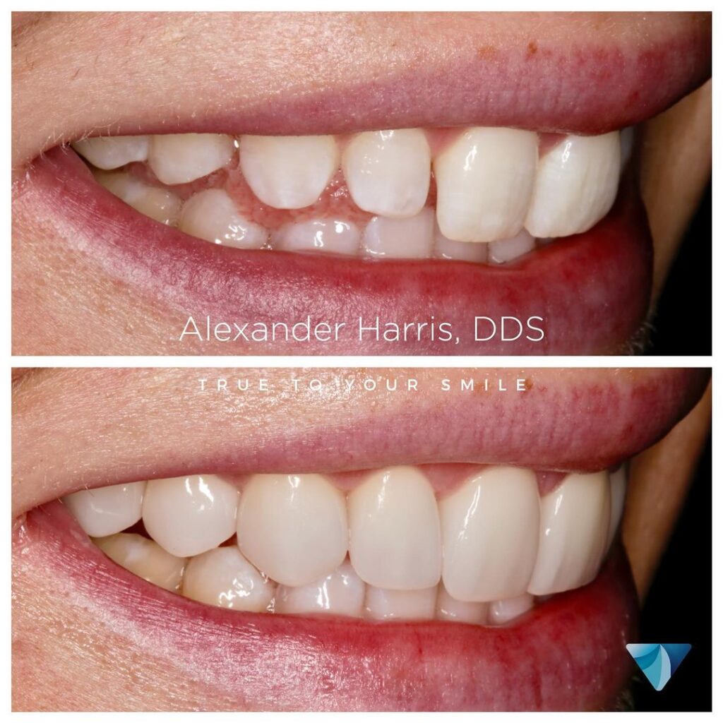 Lehi UT dental veneers before and after photo at Vero Dental with Dr. Harris