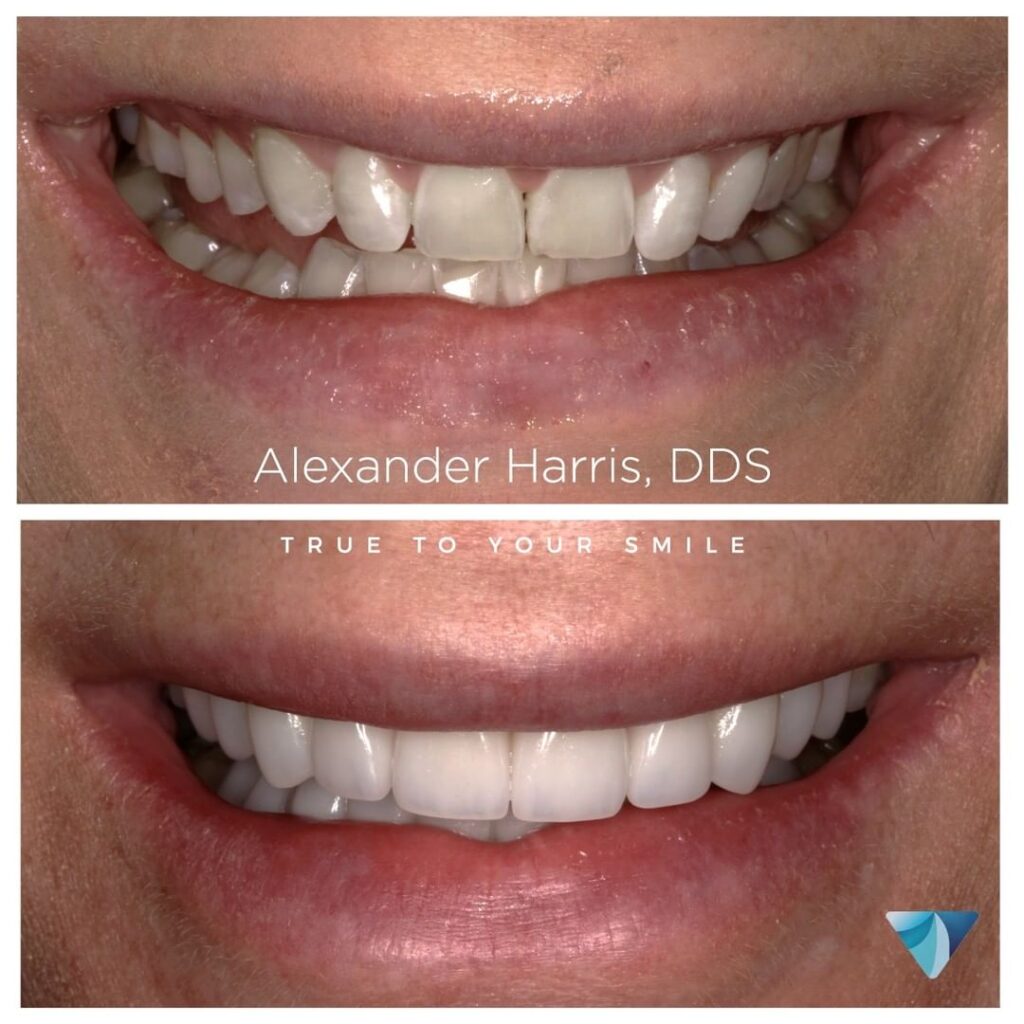 Dental veneers and dental crowns before and after photo