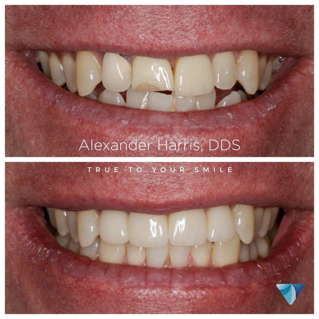Patient before and after photos who received dental crowns and veneers at Vero Dental in Lehi, UT