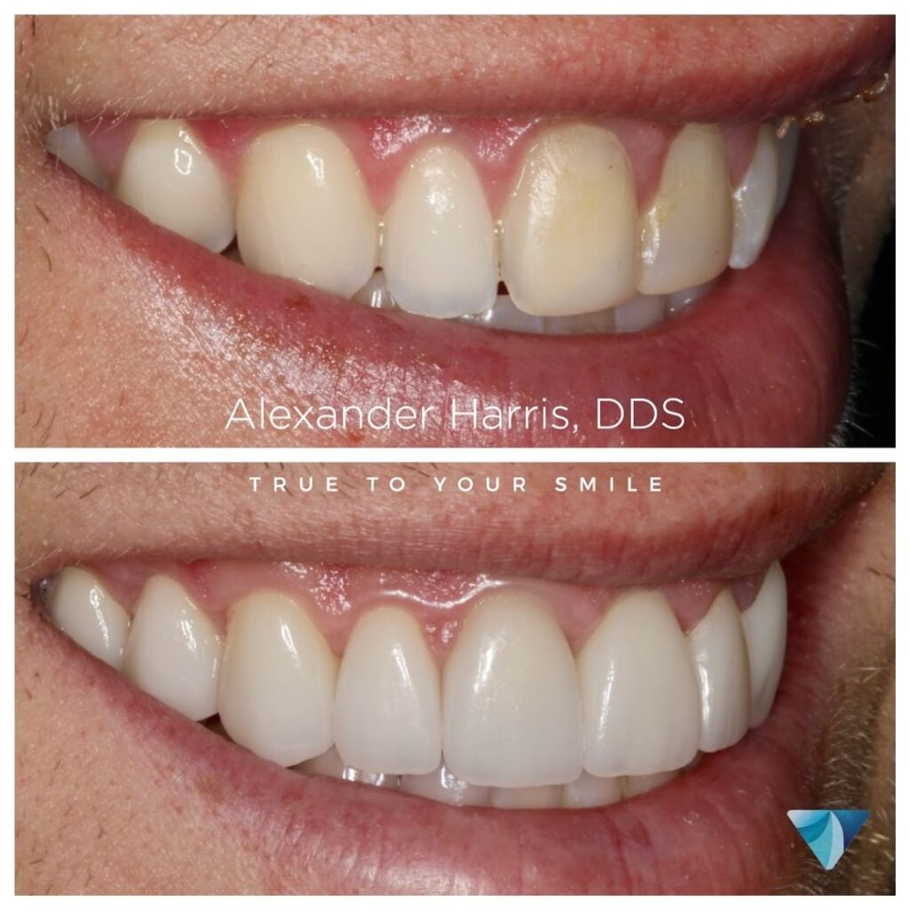 Before and after photo where broken teeth were fixed by veneers