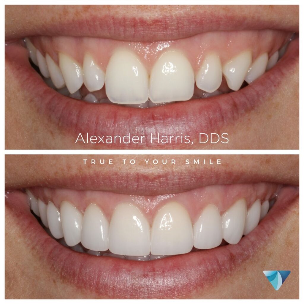 Veneers and gum contouring before and after patient photos