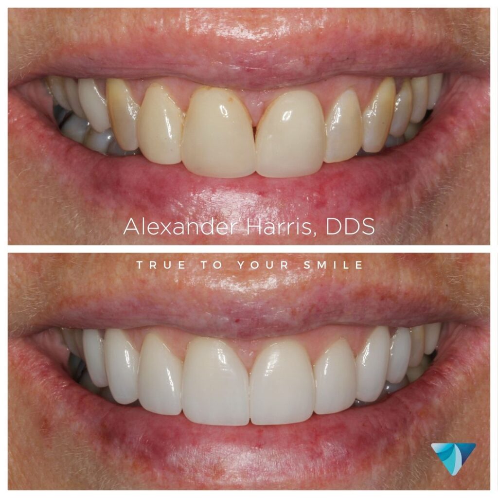 Before and after dental veneers replacement patient photos in Lehi, UT