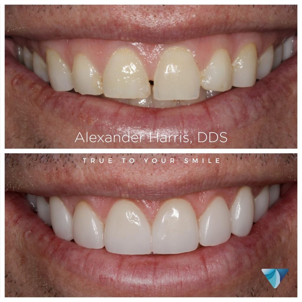 Patient before and after photos from teeth whitening and dental veneers in Lehi, UT