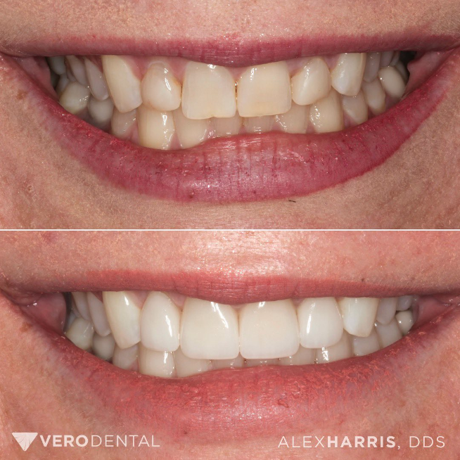 Lehi UT cosmetic dentistry patient before and after teeth whitening and gum contouring photos