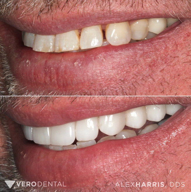 Dental crowns and veneers patient before and after photos at Vero Dental in Lehi, UT