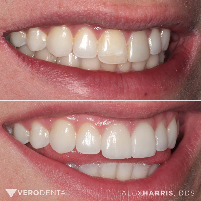 Smiling patient before and after photos after receiving 2 dental veneers from Vero Dental