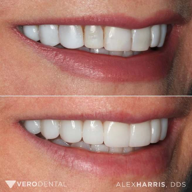 Smile design dental veneers patient before and after photo in Lehi Utah