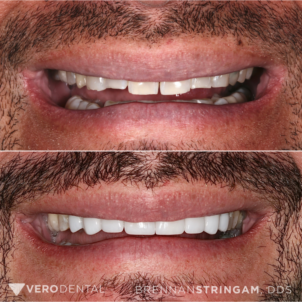Veneers patient before and after photos