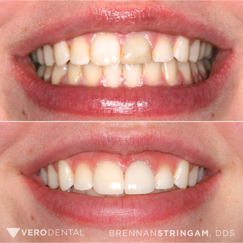 Dr. Brennan Stringam patient before and after treatment photo